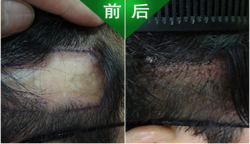 广州倍生植发疤痕修复案例