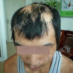 河南现代植发孔先生疤痕植发案例对比