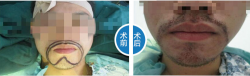 南宁雍禾植发胡须种植案例