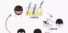 一次毛发移植，解决一辈子心“头”烦恼