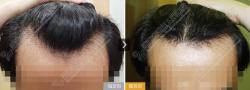 江西广济医院毛发移植中心发际线案例