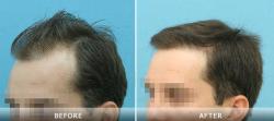 解放军211医院植发中心植发际线案例