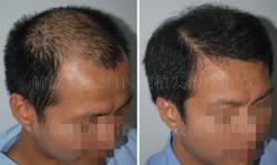 解放军211医院植发中心植发案例