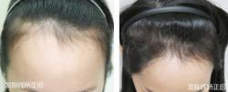 韩国forhair医院女性发际线矫正手术案例