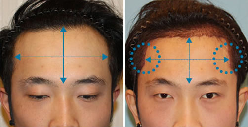 韩国毛杰琳毛发移植中心男性植发术后效果对比