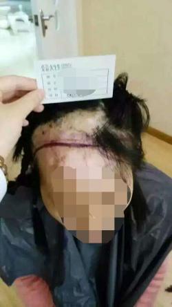 武汉久生生疤痕植发案例