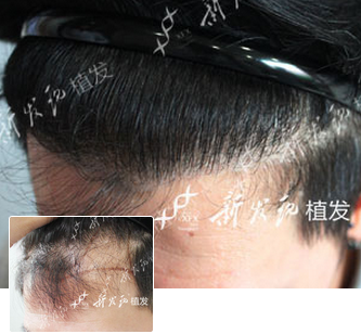 广州新发现发际线植发案例