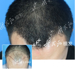广州新发现植发案例