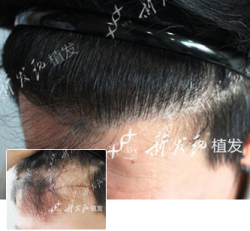 广州新发现发际线植发案例