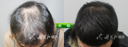 天津新发现植发案例