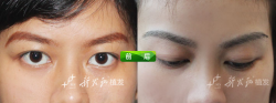 天津新发现眉毛种植案例