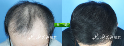 天津新发现植发案例