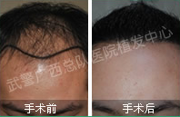 广西总队医院植发中心植发案例