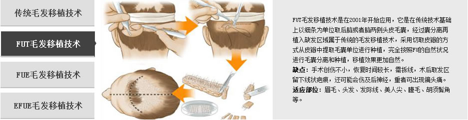 下面带大家来了解一下佳美的毛发移植技术吧~