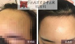 岳氏中医堂发际线下移案例