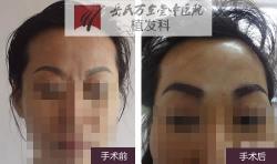 岳氏中医堂眉毛前后案例