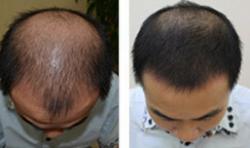 岳氏中医堂徐先生植发案