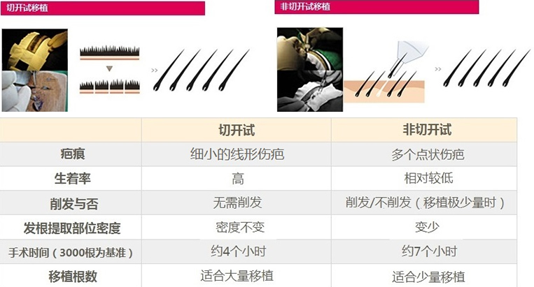 韩国奥拉克清潭店毛发移植中心植发技术介绍