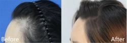韩国毛补莱斯毛发移植医院通过发际线矫正让女性年轻