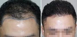 自然卷曲头发能植发吗？深圳卷发种植2800单位效果图