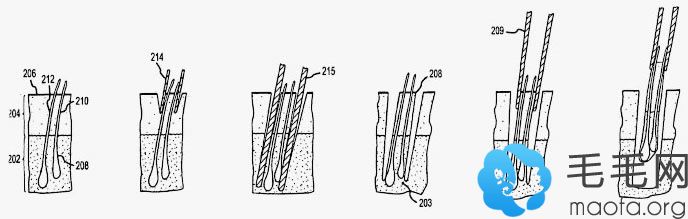 壹加壹毛发移植中心植发过程演示图