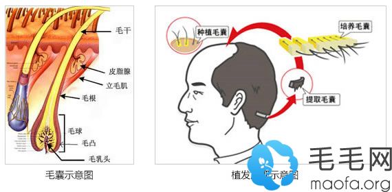 壹加壹植发中心植发原理示意图