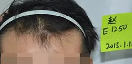 看我在植发植发1300单位一到四个月效果图