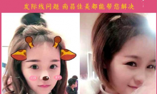 南昌佳美整形医院公司高管&校花真人PFUE无痕毛发移植日记