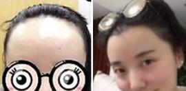 女生额头高怎么办？种植发际线2个月摆脱困扰20年大额头