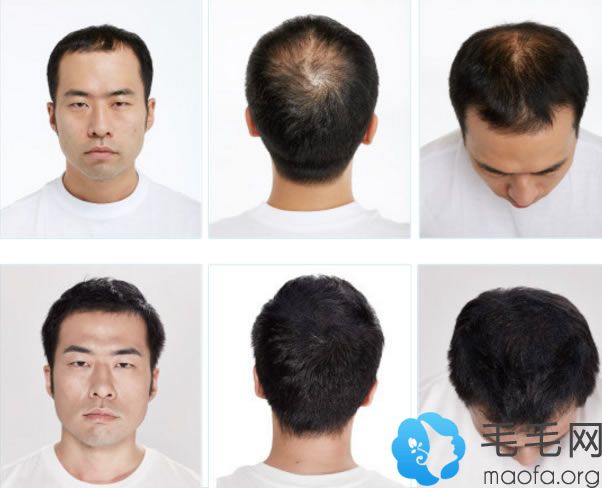 韩国FORHAIR毛发移植案例图