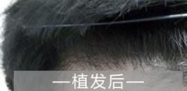 植發(fā)后多久開始生長新頭發(fā)？有什么辦法能讓長快點兒？