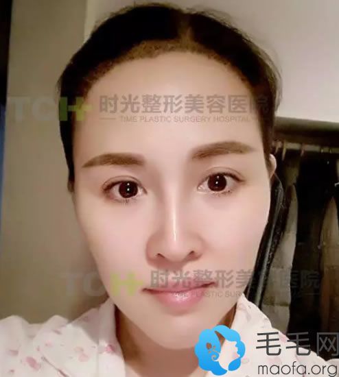 江女士種植發(fā)際線7天的時候