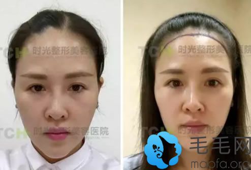 楊主任為江女士設(shè)計的發(fā)際線