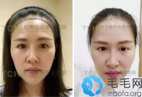 江女士發(fā)際線種植1個月的對比照片