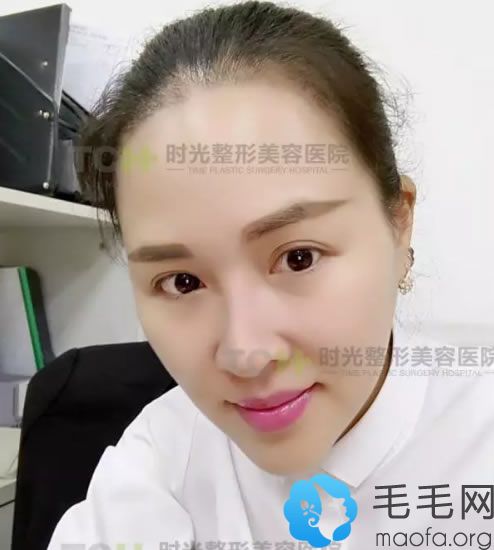 江女士植發(fā)手術(shù)1個月的照片