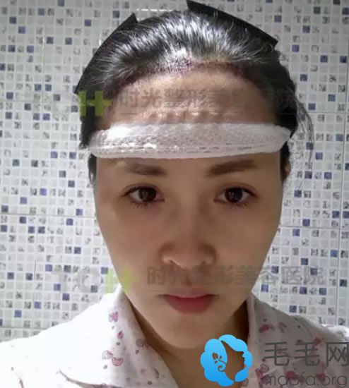 江女士植發(fā)手術(shù)當(dāng)天的照片