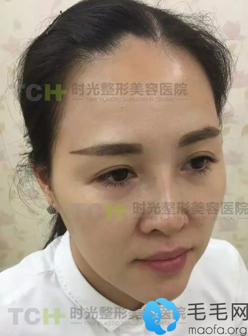 江女士植發(fā)前凹凸不平的發(fā)際線