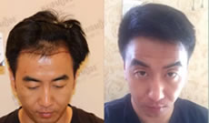 植发是真的假的？看看马亮分享发际线种植9个月效果
