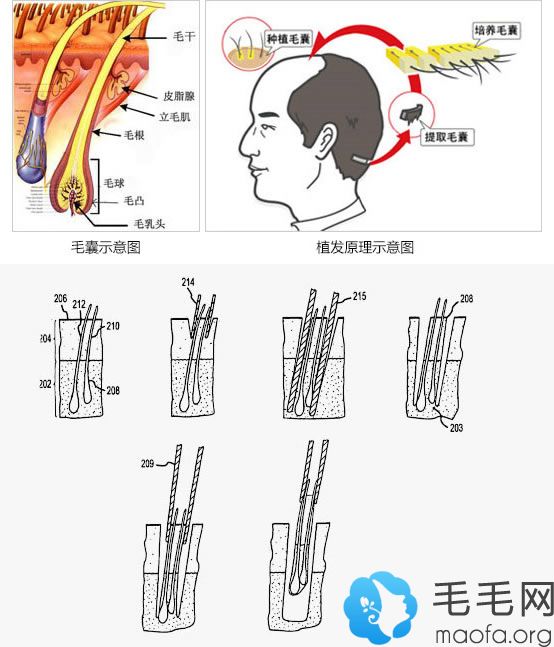 宁波壹加壹植发原理及手术过程