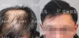 四級(jí)脫發(fā)潘先生在植發(fā)中心種植頭發(fā)一年恢復(fù)過程