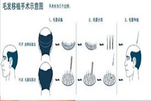 走访调查沈阳植发得到的正规植发医院排名及价格表