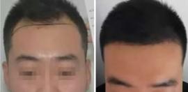 植發(fā)要剃光頭嗎 不理發(fā)種植2000單位恢復(fù)效果來回答