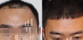 植眉效果好吗？展示北京眉毛移植效果对比图