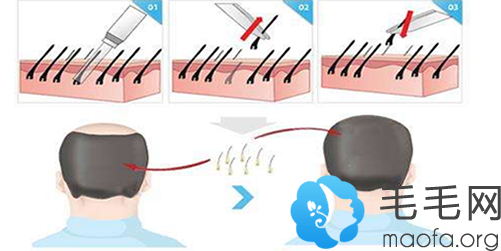 摆脱脱发的方法：头发种植