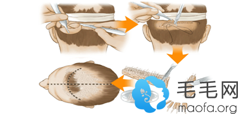 毛发移植过程