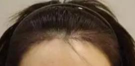 发际线过高拉低了你的颜值 那就通过种植发际线来调整吧