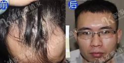我是M+O型遗传脱发，一年前在郑州科发源植发了2500单位