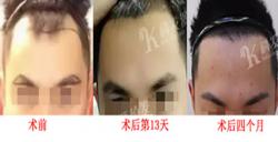 从多组头发种植案例及恢复效果看广州科发源植发靠谱吗