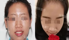 包子脸美眉在广州弘基植眉之后是如何变成小V脸的