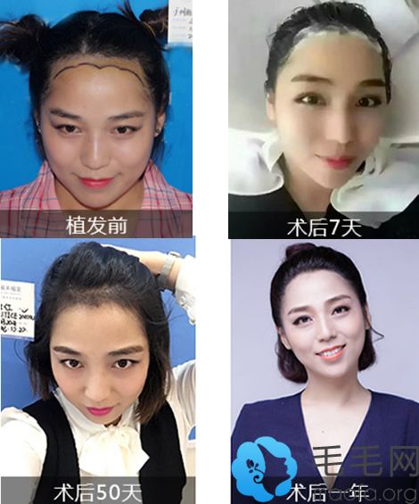 雍禾女士植发过程及效果